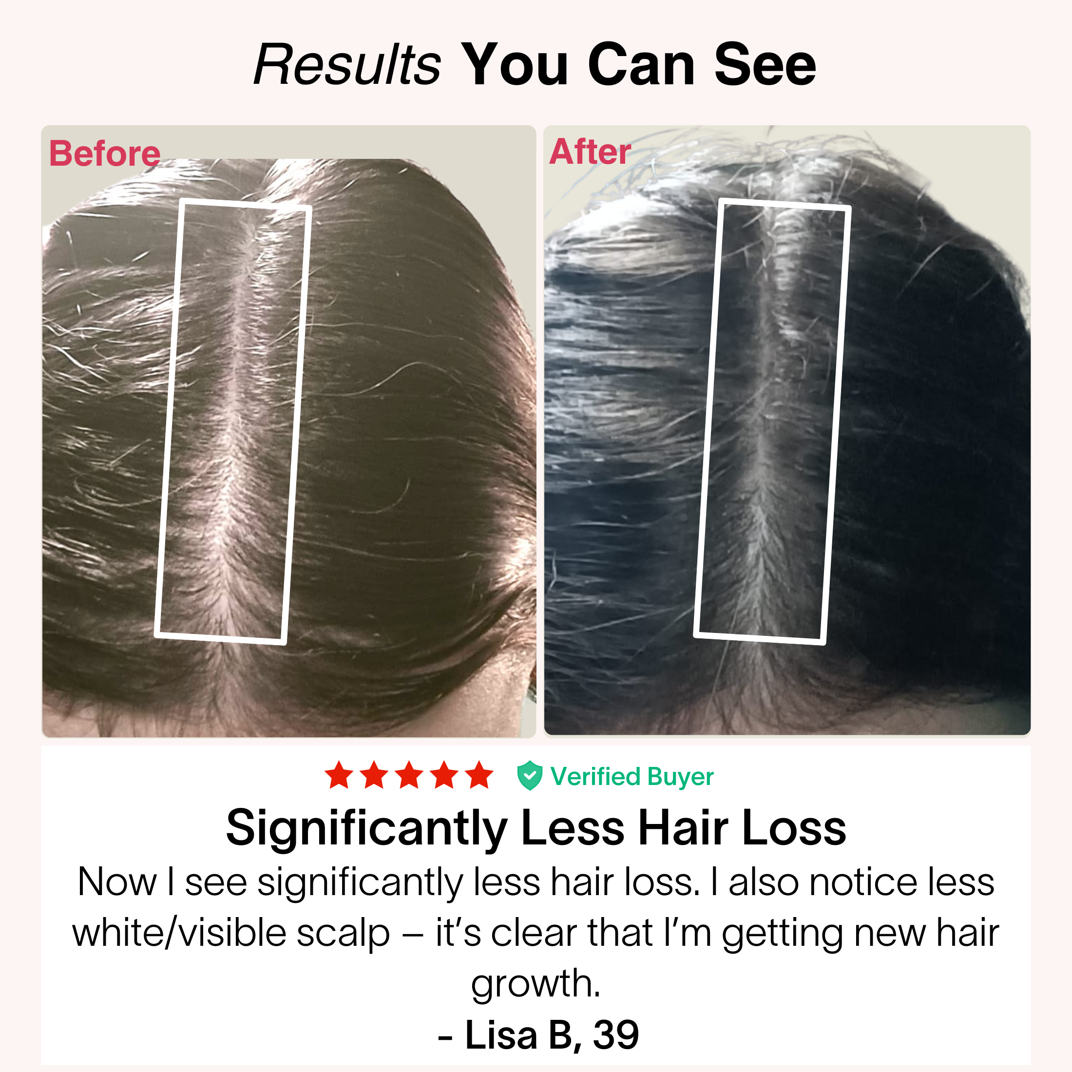 TheraCapX® Hair Growth System