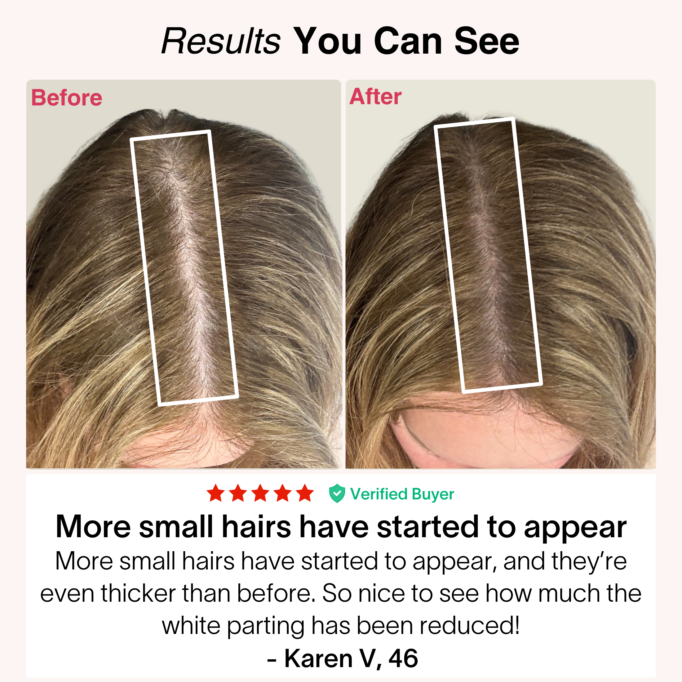 TheraCapX® Hair Growth System