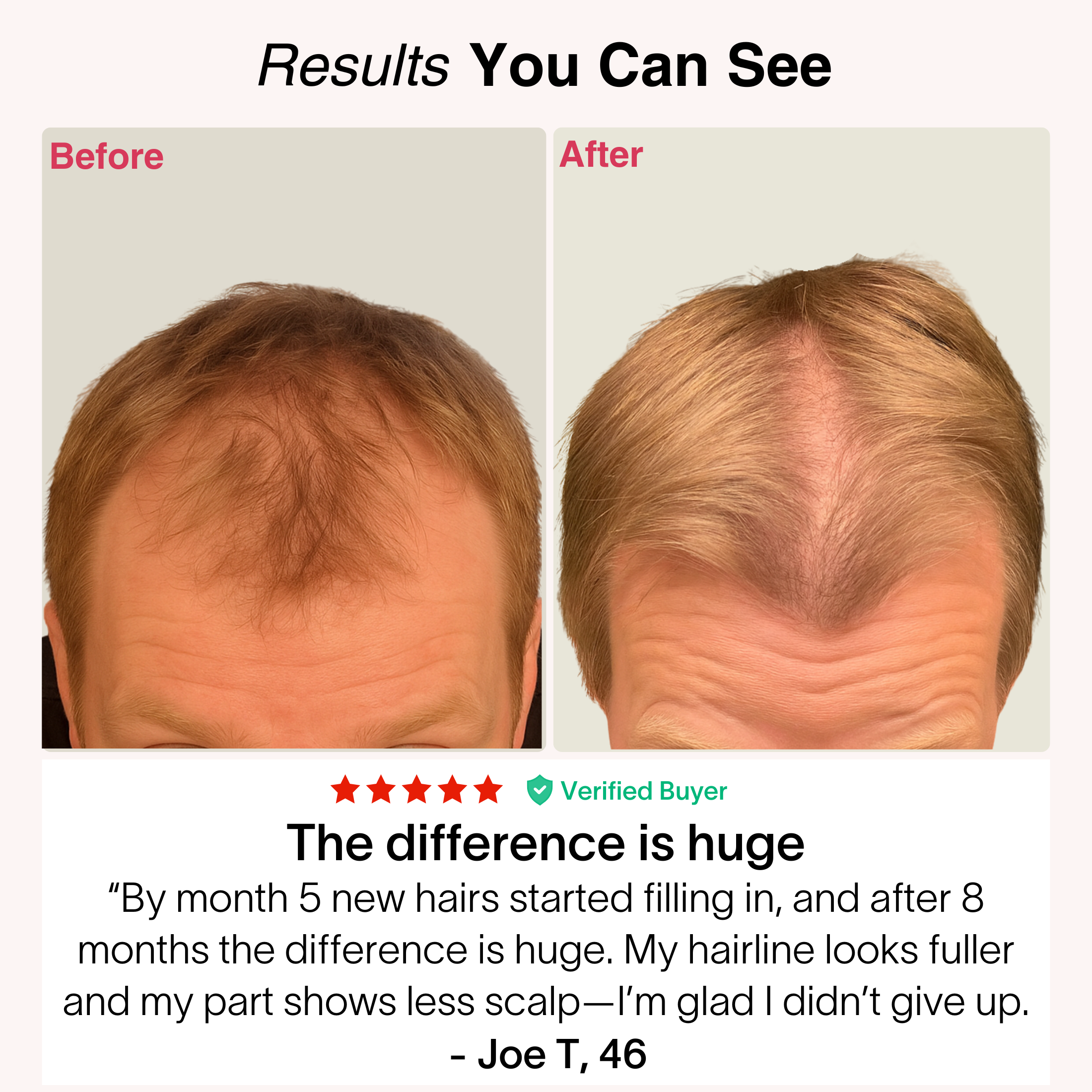 TheraCapX® Hair Growth System