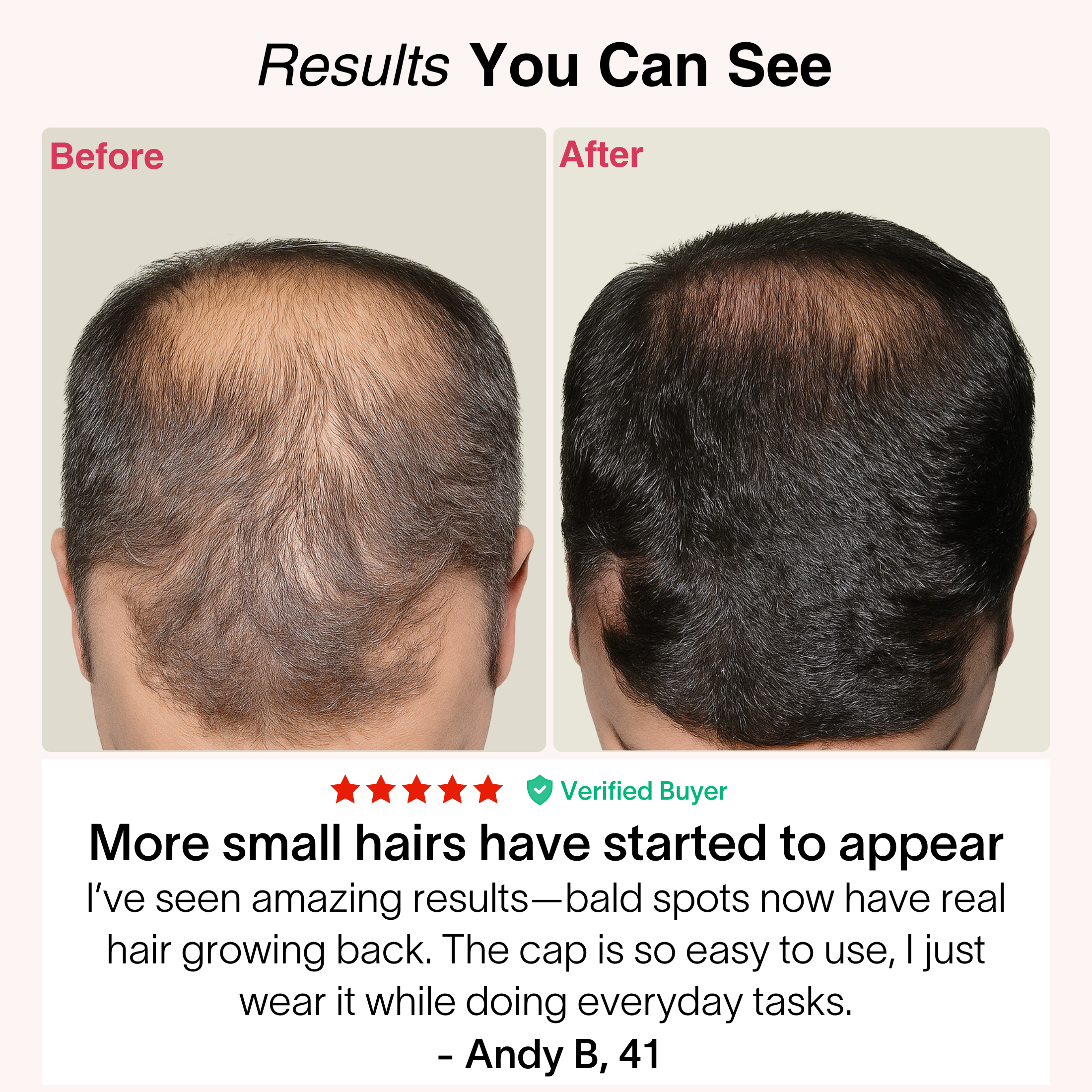 TheraCapX® Hair Growth System